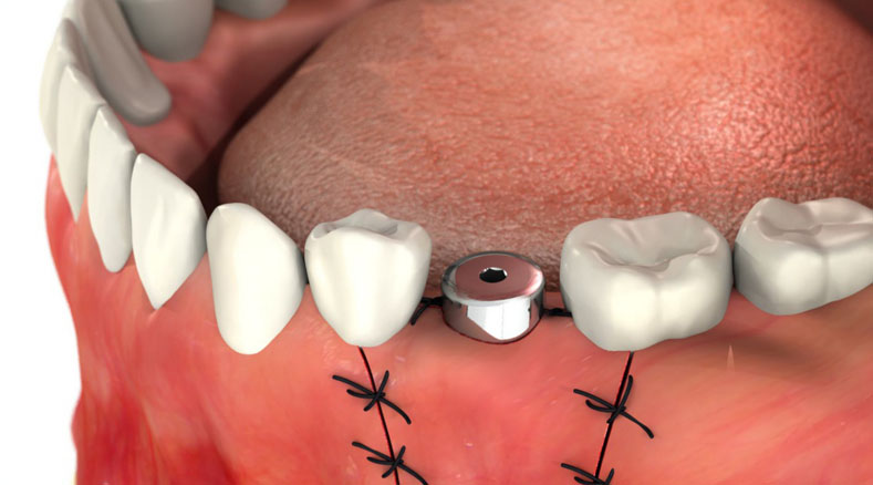 Реабилитация после операции по установке зубного имплантата